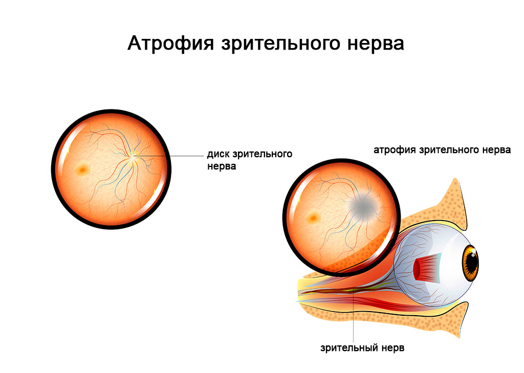 Лечение и диагностика заболеваний сетчатки и  диска зрительного нерва